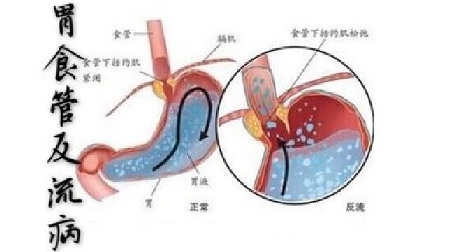 胃食管反流病呈现年轻化趋势，与爱喝甜饮有关
